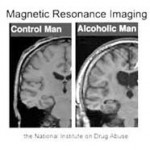 Alcohol’s Damaging Effects on the Brain